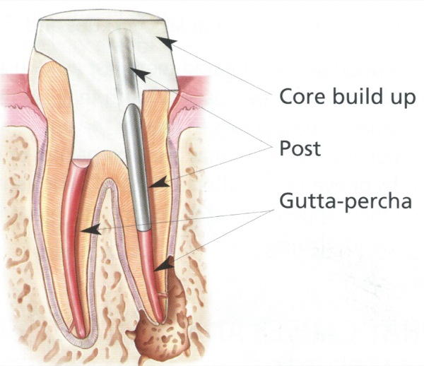 After Treatment Scripps Mesa Endodontics